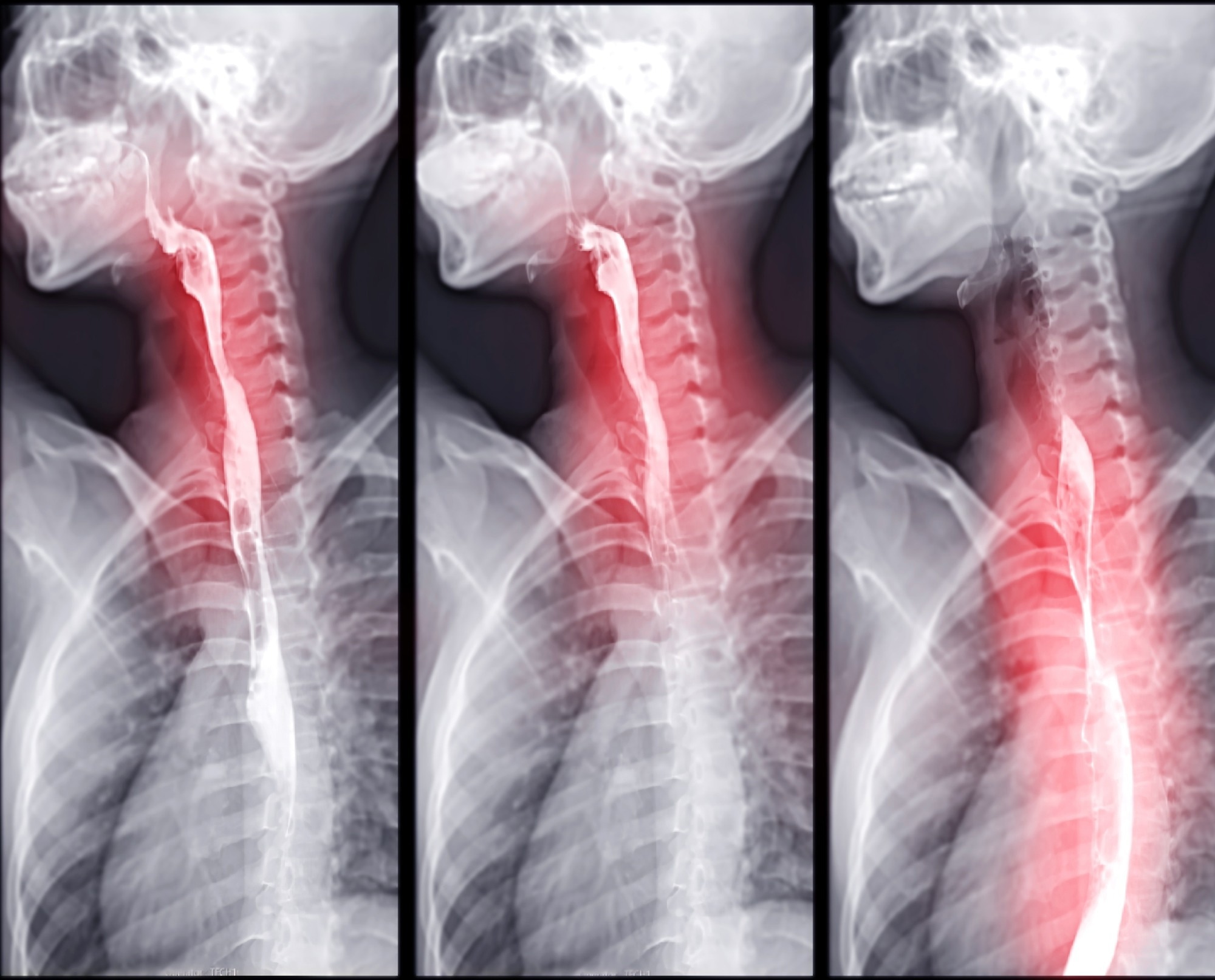 Barium swallow X-ray imaging showing contrast passing through the esophagus
