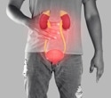 A New Approach to Preventing Bladder Cancer Recurrence