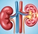 Is a high-protein diet hard on your kidneys?