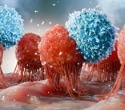 Infections caused 1 in 8 cancer cases worldwide in 2024, study finds