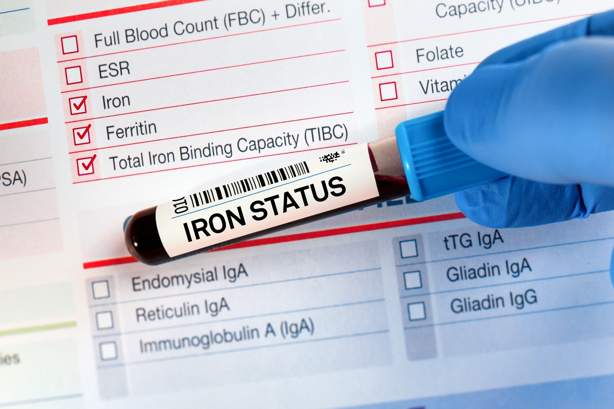 New iron deficiency guidelines raise key blood test cutoffs