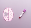A study links a blood protein to memory and brain changes in Down syndrome