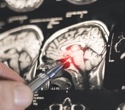 AI helps neurologists distinguish epilepsy from functional seizures