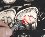 AI helps neurologists distinguish epilepsy from functional seizures