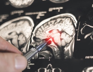 AI helps neurologists distinguish epilepsy from functional seizures