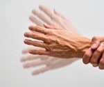 Year-long trial finds NAD-boosting supplement fails to improve early Parkinson's symptoms