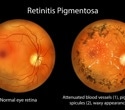 Gene therapy and special goggles help some blind adults detect objects again