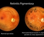 Gene therapy and special goggles help some blind adults detect objects again