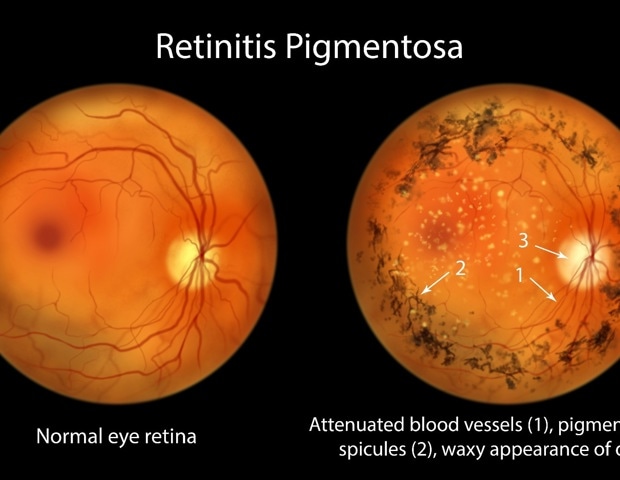 Gene therapy and special goggles help some blind adults detect objects again