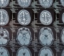 What can 6,000 brain scans tell us about Alzheimer's?