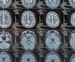 What can 6,000 brain scans tell us about Alzheimer's?