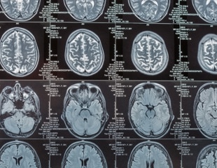 What can 6,000 brain scans tell us about Alzheimer's?