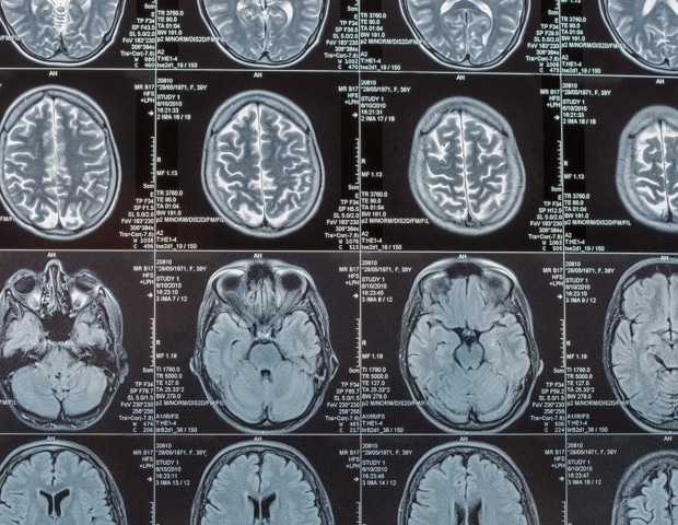 What can 6,000 brain scans tell us about Alzheimer's?