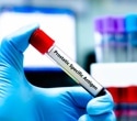 Clues to prostate cancer risk in blood samples taken 15 years earlier