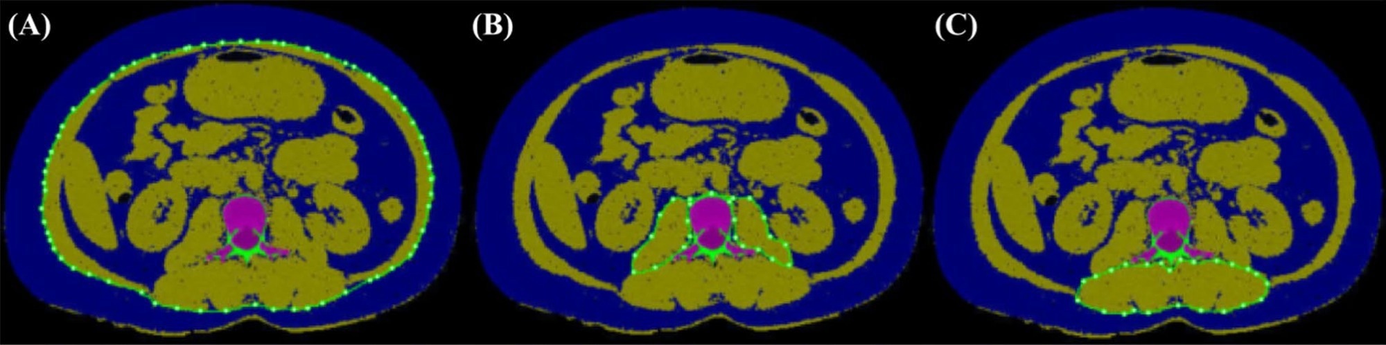 Regions of interest (ROIs) for QCT-based body composition analysis at the L2 vertebral level. (A) Quantification of visceral adipose tissue (VAT) and subcutaneous adipose tissue (SAT) at the L2 vertebral level on QCT images. The ROI is demarcated by the green contour; the blue area within this ROI denotes VAT, while the blue area outside the ROI corresponds to SAT. (B) Quantification of the psoas major muscle (PMM) at the L2 vertebral level on QCT images. The PMM is defined by the green ROI contour, with the yellow area within this contour representing the PMM. (C) Quantification of the erector spinae muscle (ESM) at the L2 vertebral level on QCT images. The ESM is outlined by the green ROI contour, with the yellow area within this contour representing the ESM