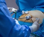 CT scans linked vitamin D levels to fat within muscles after bariatric surgery