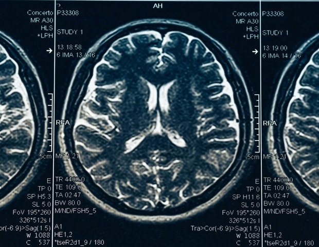 Study identifies early risk factors for progressive supranuclear palsy