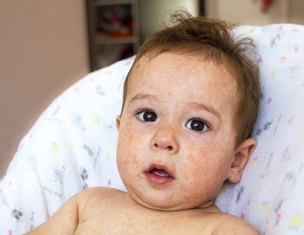 New EAACI guidelines for effective allergy management