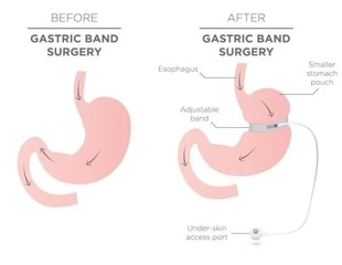 Semaglutide helps patients who gain weight after bariatric surgery