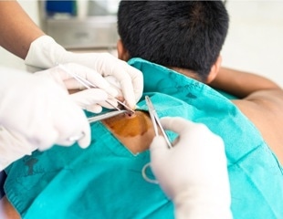 Researchers who study HED identify mechanism that may be disrupted in male pattern baldness