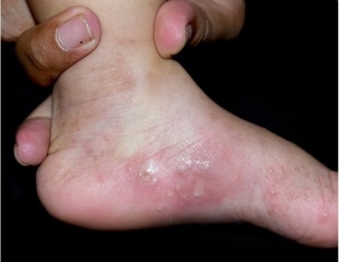 Study reveals a link between genital warts and the human leukocyte antigen system