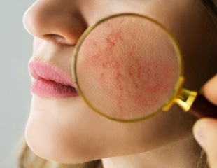 Researchers identify new molecular mechanisms in chronic skin inflammation