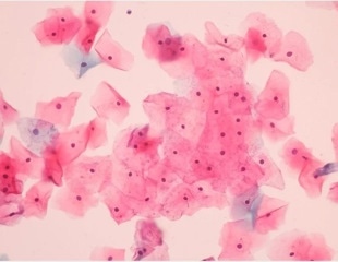 American women show varied preferences for in-clinic versus at-home cervical cancer screening