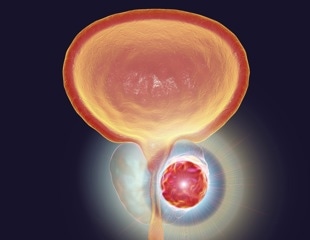 Low baseline testosterone predicts aggressive prostate cancer progression risk