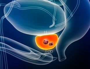 Transforming prostate screening into a global gold standard