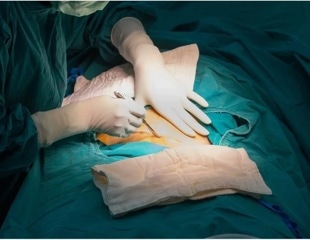 Vaginal seeding engrafts maternal bacteria in the bodies of cesarean section born neonates