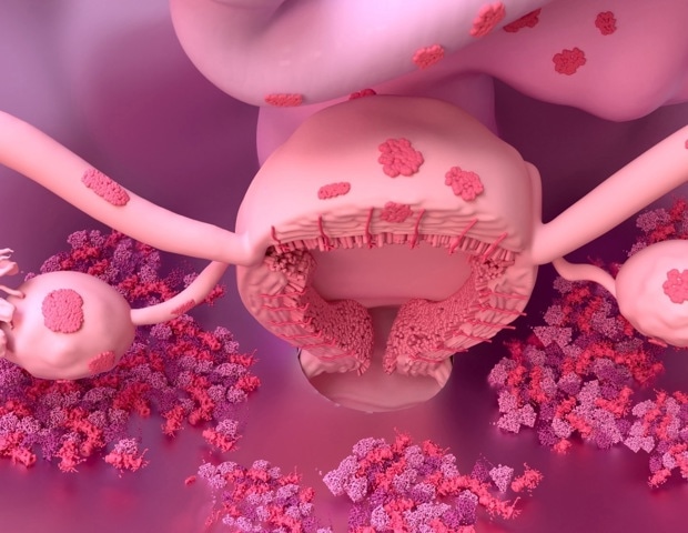 Taller individuals face higher risk of endometriosis and atrial fibrillation