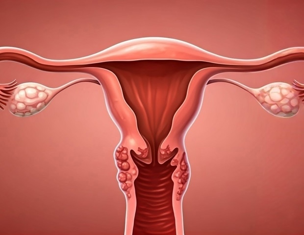 Modern pollutants and ancient genetic variants could explain why some women develop endometriosis