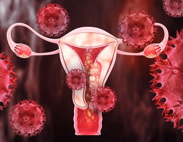 The new 5-minute screening tool for endometriosis detection