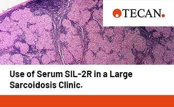 Clinical insights into sIL-2R for sarcoidosis